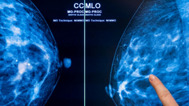 Fat cells may fuel aggressive breast cancers: Study