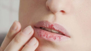 Do lips and mouth sores occur in winter? How to cure them at home