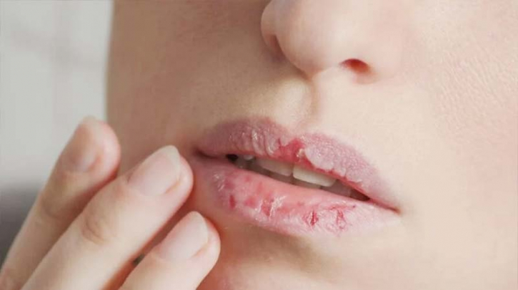 Do lips and mouth sores occur in winter? How to cure them at home
