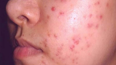 Why do you get acne, are you worried about it? Why do you get acne, are you worried about it?