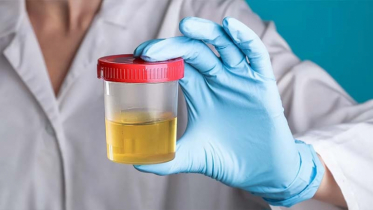 The color of urine is cloudy without any reason The color of urine is cloudy without any reason