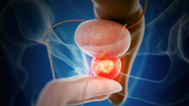 Signs that will help you understand prostate cancer, what to do?