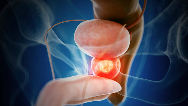 Signs that will help you understand prostate cancer, what to do? Signs that will help you understand prostate cancer, what to do?