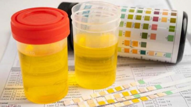 Does the color of your urine change too?