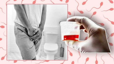White discharge with urine?—Isn’t it a sign of kidney failure?