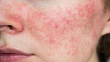 Face is covered in red rashes in summer