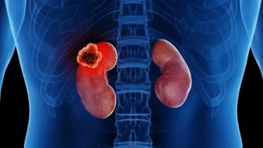 What is kidney cancer? 7 common misconceptions and facts