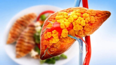 5 foods to avoid to control fatty liver
