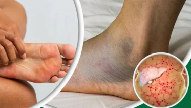 Your feet will tell you if you have liver problems